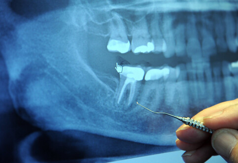 Electro-conductive & Antibacterial Material for Endodontic Treatment