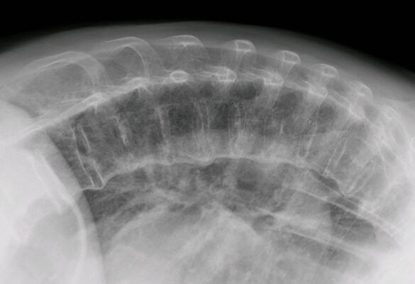 Small Molecules to Treat Skeletal Disorders Caused by Integrated Stress Response