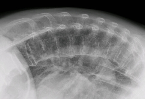 Small Molecules to Treat Skeletal Disorders Caused by Integrated Stress Response