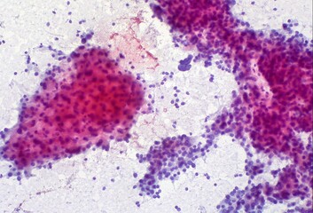 Anti-DKK1 Monoclonal Antibody for Liver Cancer Treatment