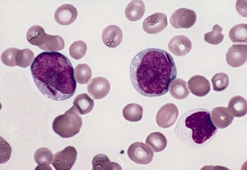 The First Class of Inhibitors for YEATS Domain as Potential Therapeutic Agents for Acute Leukemia
